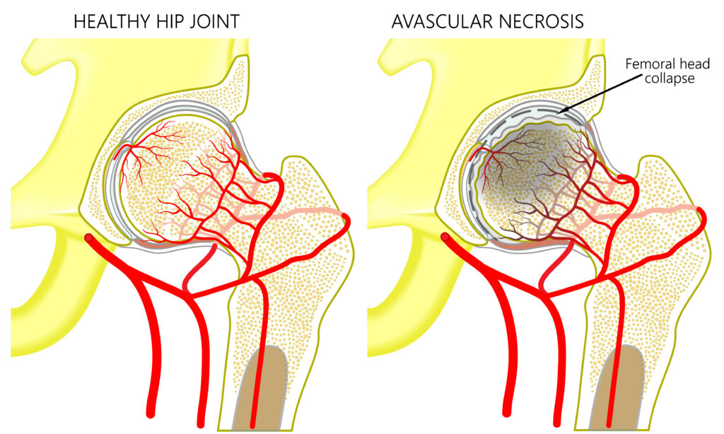 Necrose da cabeça do fêmur