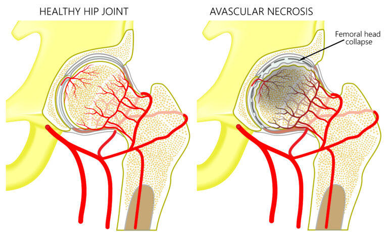 Osteonecrose Da Cabeça Femoral - Artroplastias